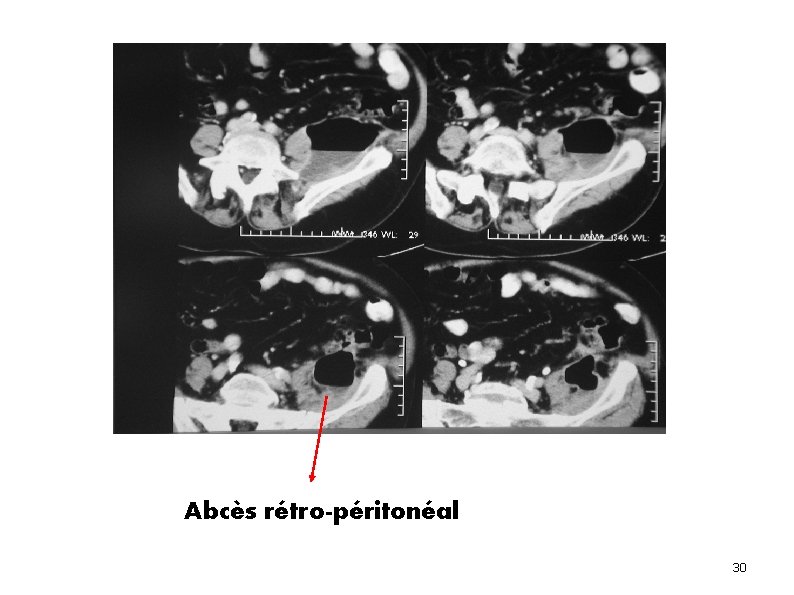 Abcès rétro-péritonéal 30 