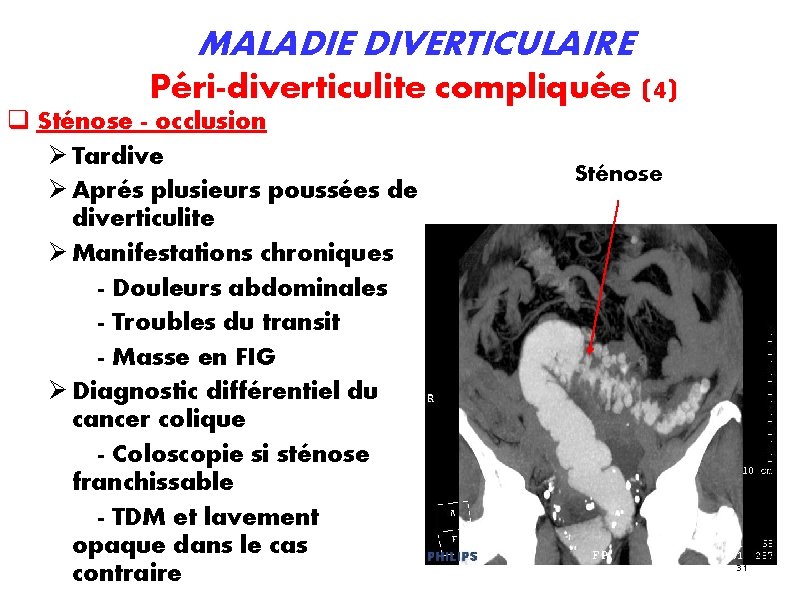 MALADIE DIVERTICULAIRE Péri-diverticulite compliquée (4) Sténose - occlusion Tardive Aprés plusieurs poussées de diverticulite MALADIE DIVERTICULAIRE Péri-diverticulite compliquée (4) Sténose - occlusion Tardive Aprés plusieurs poussées de diverticulite