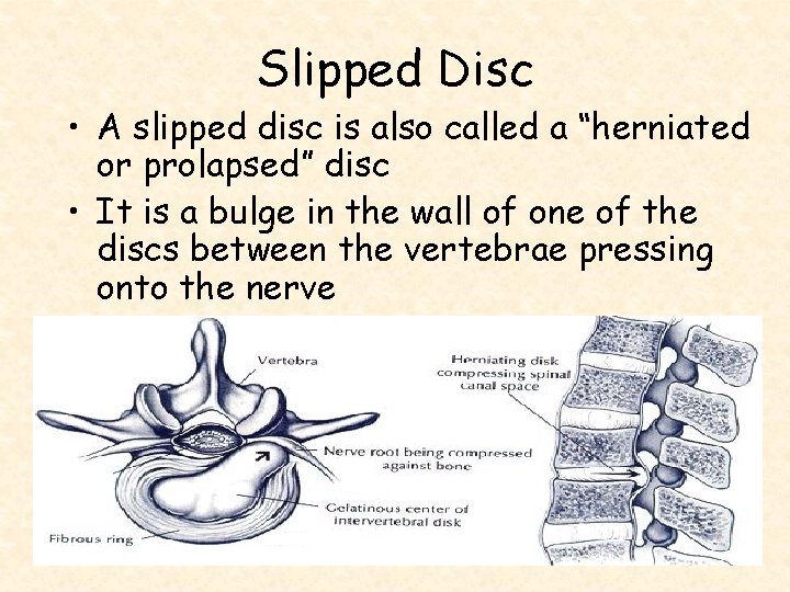 Slipped Disc • A slipped disc is also called a “herniated or prolapsed” disc