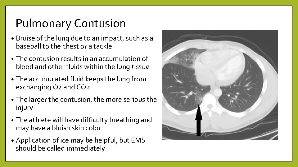 Pulmonary Contusion • Bruise of the lung due to an impact, such as a