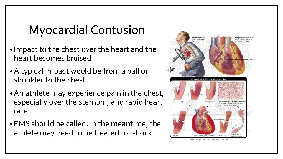 Myocardial Contusion • Impact to the chest over the heart and the heart becomes
