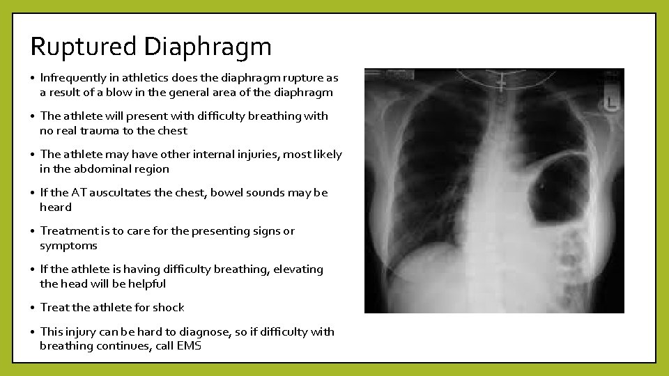 Ruptured Diaphragm • Infrequently in athletics does the diaphragm rupture as a result of