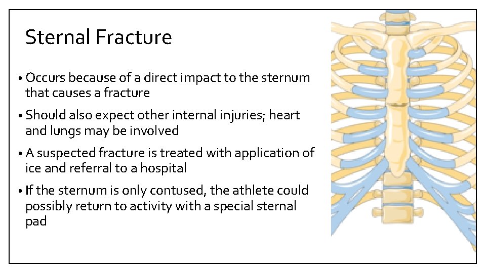 Sternal Fracture • Occurs because of a direct impact to the sternum that causes