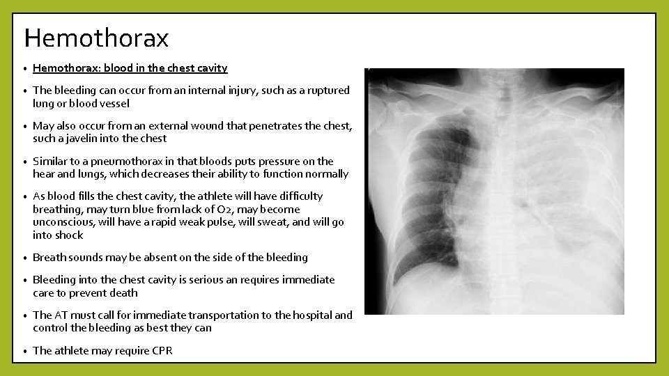 Hemothorax • Hemothorax: blood in the chest cavity • The bleeding can occur from