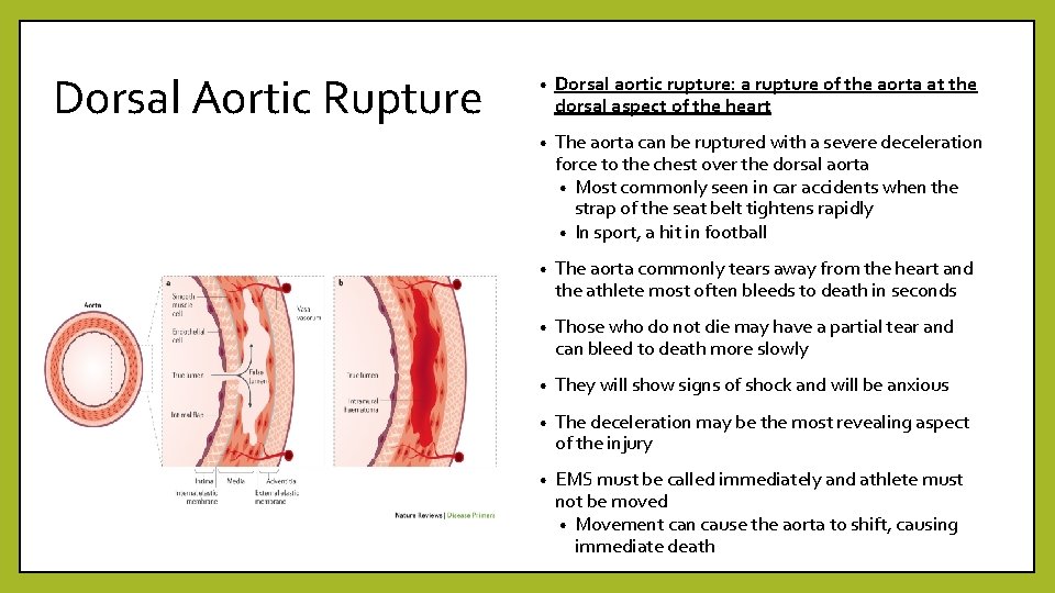 Dorsal Aortic Rupture • Dorsal aortic rupture: a rupture of the aorta at the