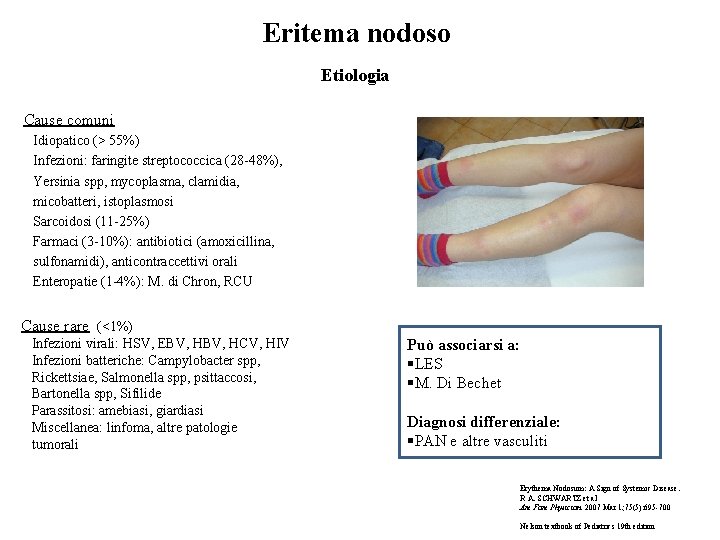 Eritema nodoso Etiologia Cause comuni Idiopatico (> 55%) Infezioni: faringite streptococcica (28 -48%), Yersinia