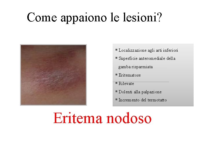 Come appaiono le lesioni? § Localizzazione agli arti inferiori § Superficie anteromediale della gamba