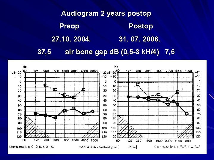Audiogram 2 years postop Preop 27. 10. 2004. 37, 5 Postop 31. 07. 2006.