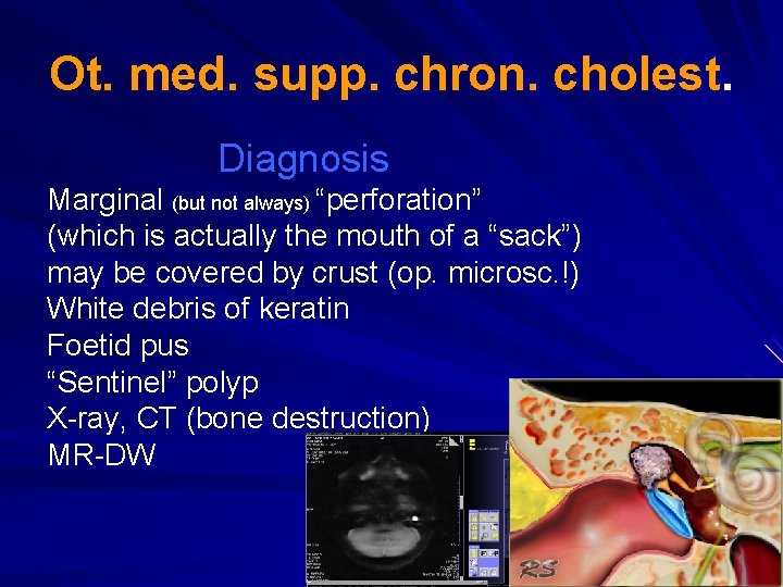 Ot. med. supp. chron. cholest. Diagnosis Marginal (but not always) “perforation” (which is actually