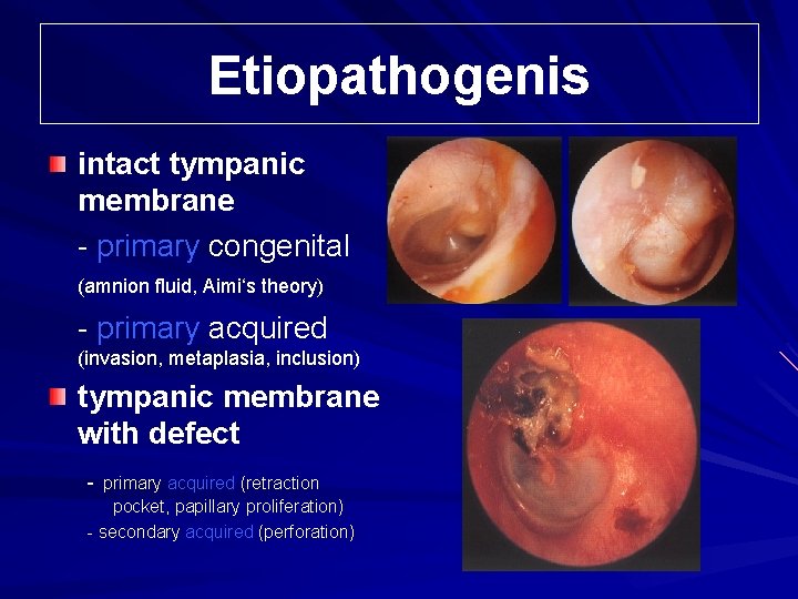 Etiopathogenis intact tympanic membrane - primary congenital (amnion fluid, Aimi‘s theory) - primary acquired