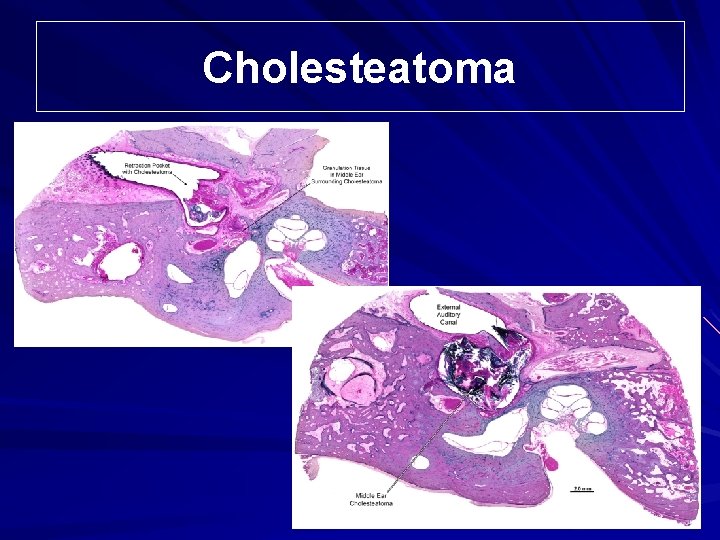 Cholesteatoma 