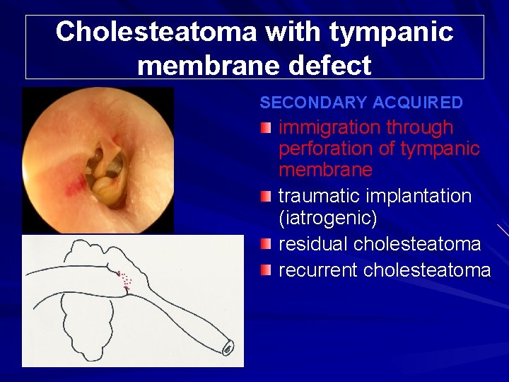 Cholesteatoma with tympanic membrane defect SECONDARY ACQUIRED immigration through perforation of tympanic membrane traumatic