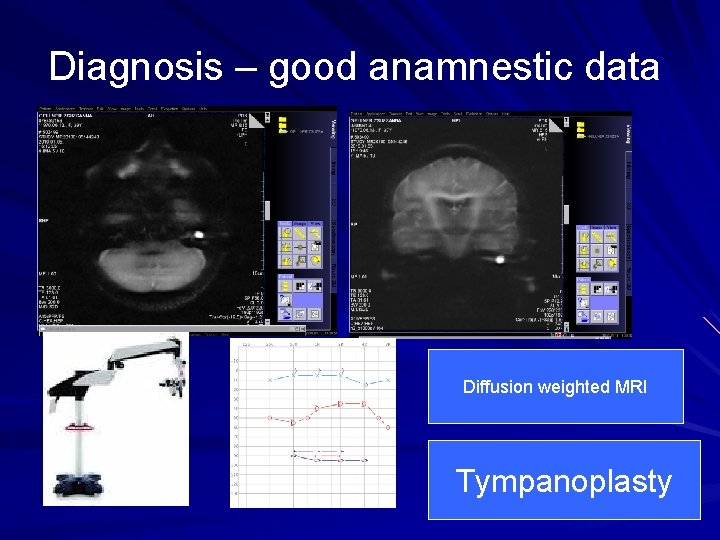 Diagnosis – good anamnestic data Diffusion weighted MRI Tympanoplasty 