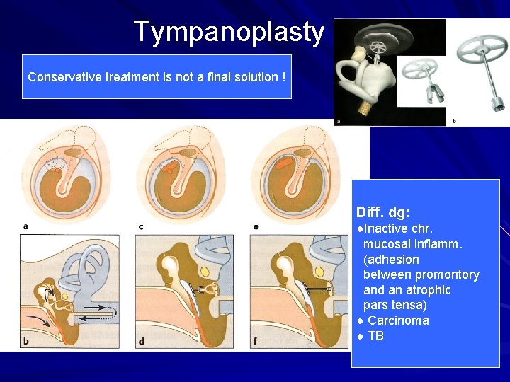 Tympanoplasty Conservative treatment is not a final solution ! Diff. dg: ●Inactive chr. mucosal