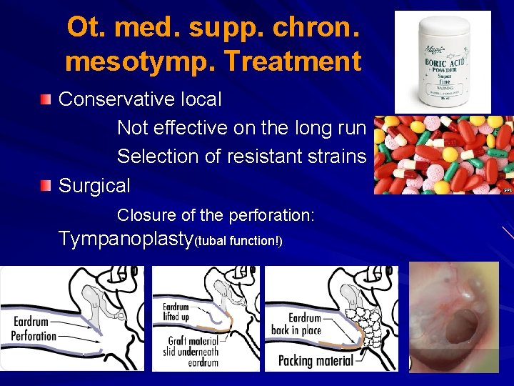 Ot. med. supp. chron. mesotymp. Treatment Conservative local Not effective on the long run