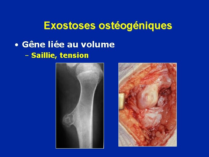 Exostoses ostéogéniques • Gêne liée au volume – Saillie, tension 