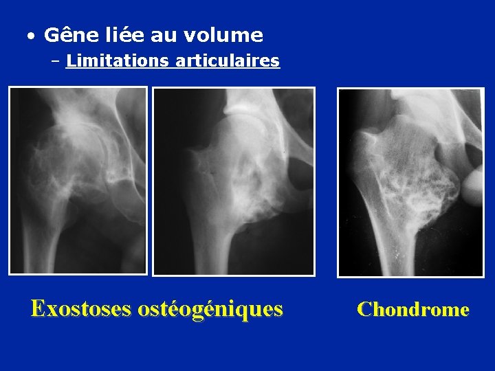  • Gêne liée au volume – Limitations articulaires Exostoses ostéogéniques Chondrome 