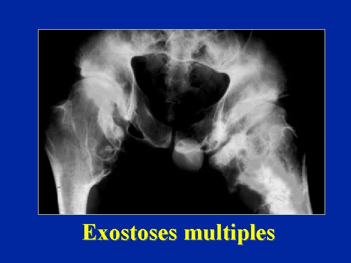 Exostoses multiples 