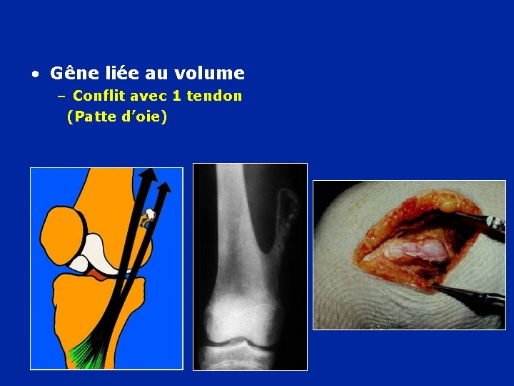  • Gêne liée au volume – Conflit avec 1 tendon (Patte d’oie) 