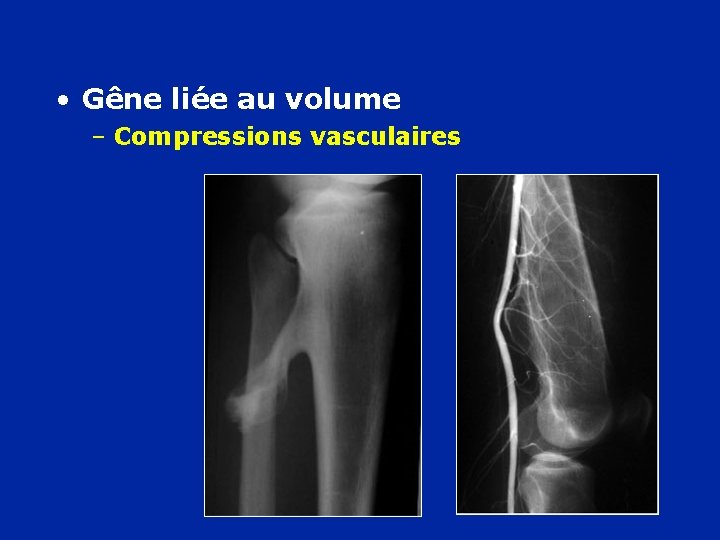  • Gêne liée au volume – Compressions vasculaires 