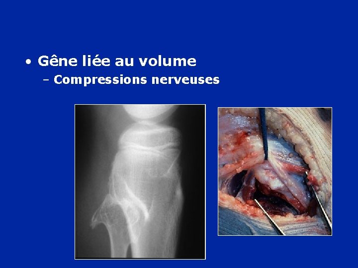  • Gêne liée au volume – Compressions nerveuses 