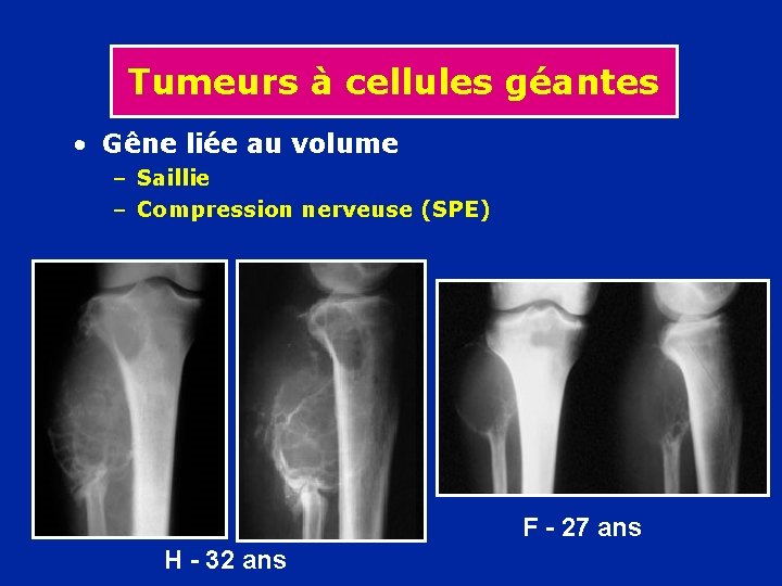 Tumeurs à cellules géantes • Gêne liée au volume – Saillie – Compression nerveuse
