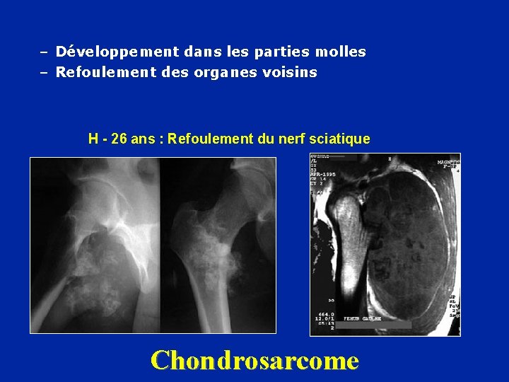 – Développement dans les parties molles – Refoulement des organes voisins H - 26