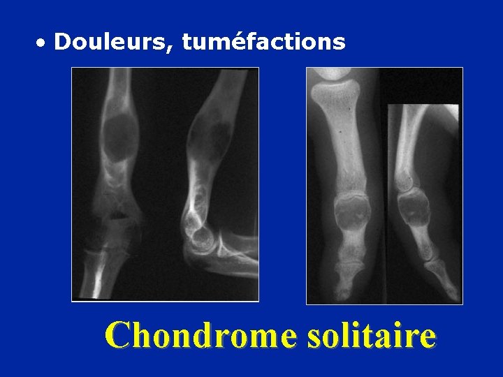  • Douleurs, tuméfactions Chondrome solitaire 