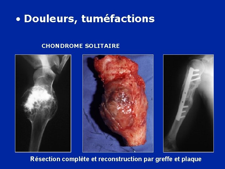  • Douleurs, tuméfactions CHONDROME SOLITAIRE Résection complète et reconstruction par greffe et plaque
