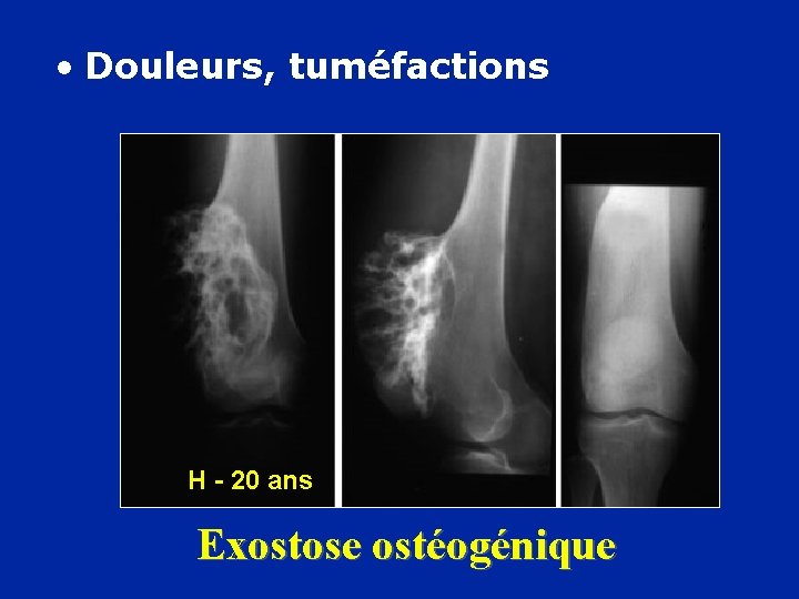  • Douleurs, tuméfactions H - 20 ans Exostose ostéogénique 