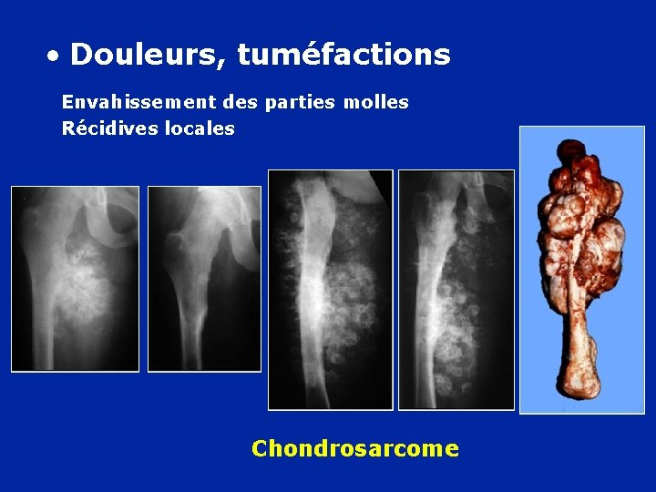  • Douleurs, tuméfactions Envahissement des parties molles Récidives locales Chondrosarcome 