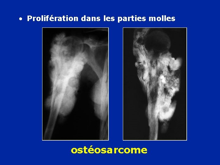 • Prolifération dans les parties molles ostéosarcome 