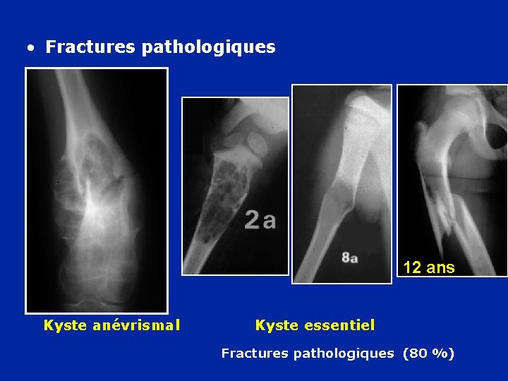  • Fractures pathologiques ans 12 12 ans Kyste anévrismal Kyste essentiel Fractures pathologiques