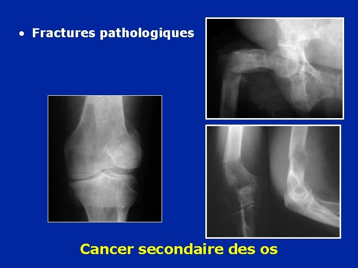  • Fractures pathologiques Cancer secondaire des os 