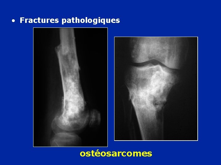  • Fractures pathologiques ostéosarcomes 