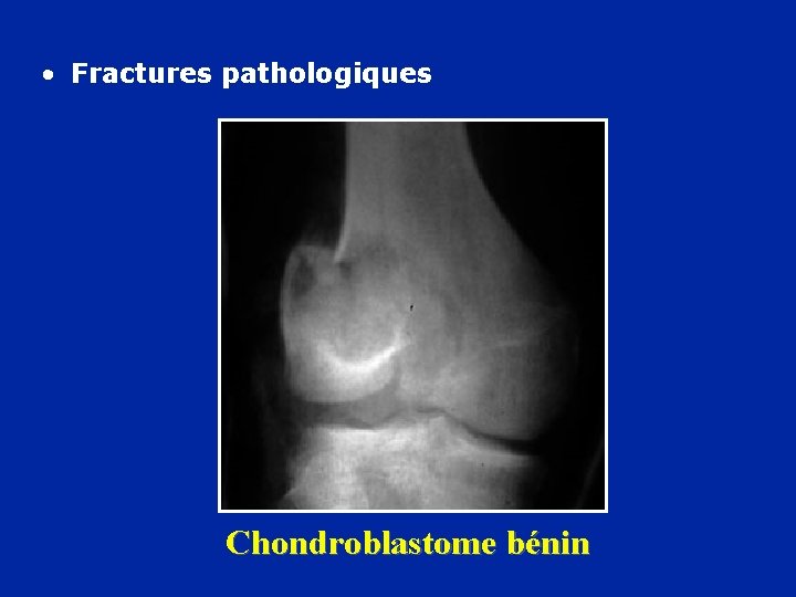  • Fractures pathologiques Chondroblastome bénin 