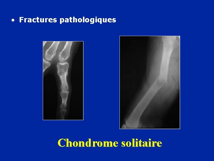  • Fractures pathologiques Chondrome solitaire 