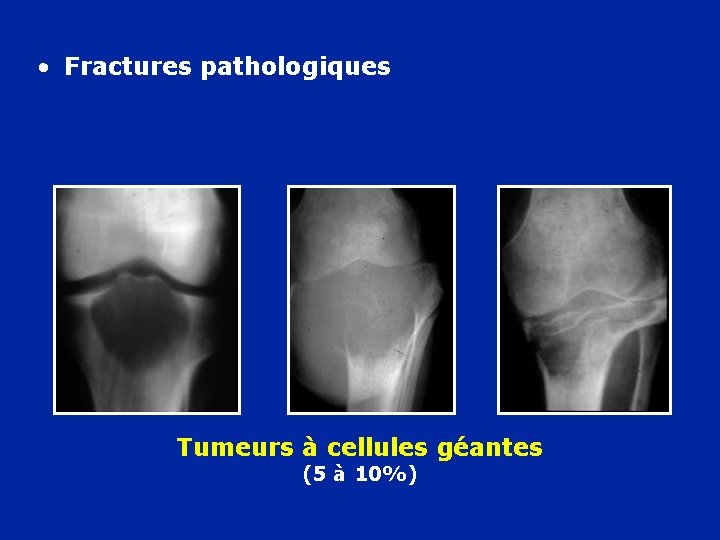  • Fractures pathologiques Tumeurs à cellules géantes (5 à 10%) 