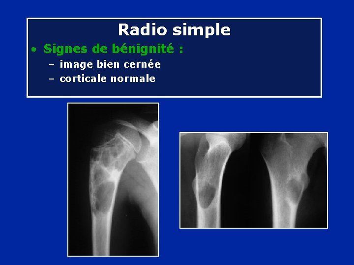 Radio simple • Signes de bénignité : – image bien cernée – corticale normale