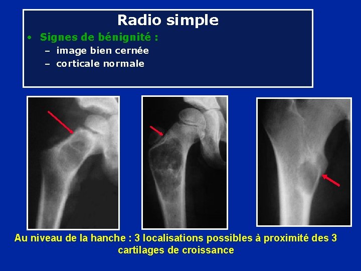 Radio simple • Signes de bénignité : – image bien cernée – corticale normale