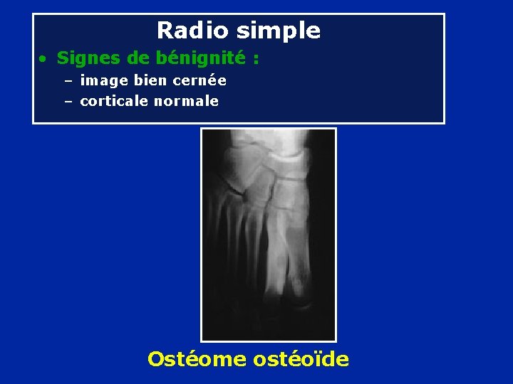 Radio simple • Signes de bénignité : – image bien cernée – corticale normale