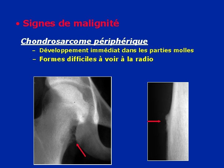  • Signes de malignité Chondrosarcome périphérique – Développement immédiat dans les parties molles