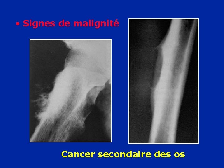  • Signes de malignité Cancer secondaire des os 