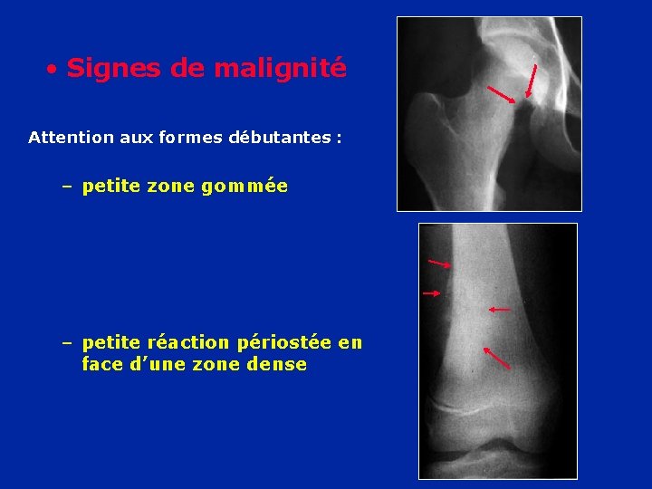  • Signes de malignité Attention aux formes débutantes : – petite zone gommée