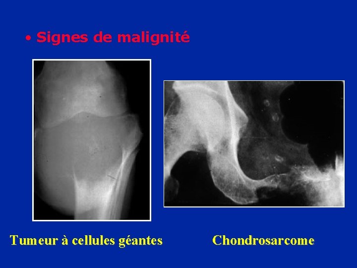  • Signes de malignité Tumeur à cellules géantes Chondrosarcome 