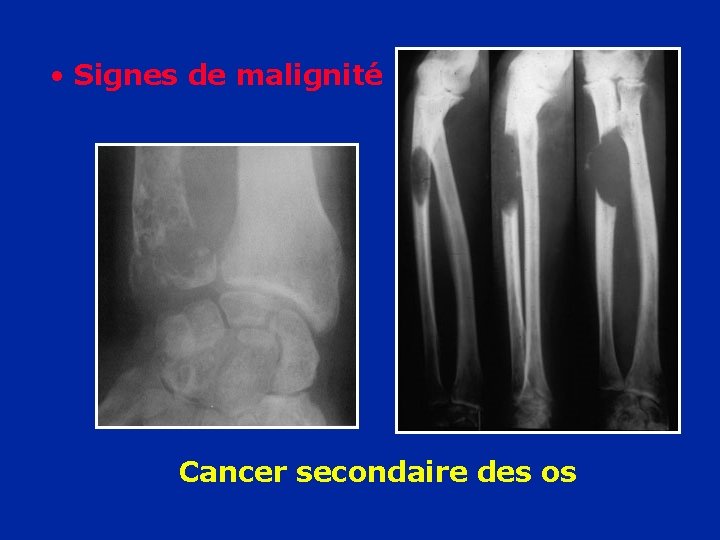  • Signes de malignité Cancer secondaire des os 