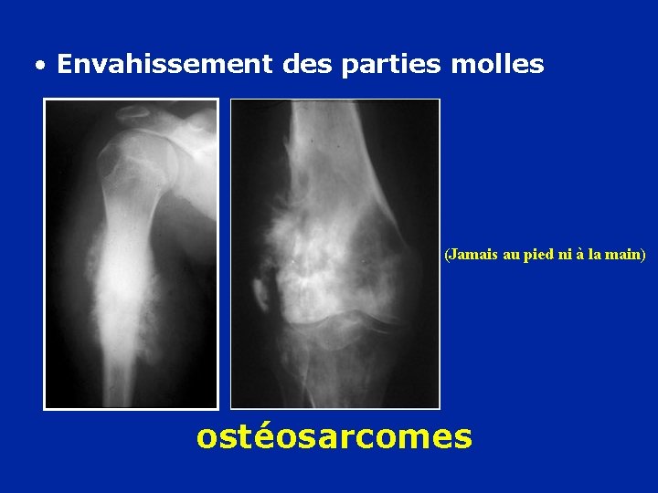  • Envahissement des parties molles (Jamais au pied ni à la main) ostéosarcomes