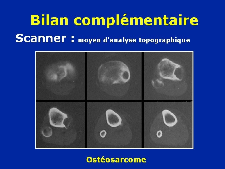 Bilan complémentaire Scanner : moyen d'analyse topographique Ostéosarcome 