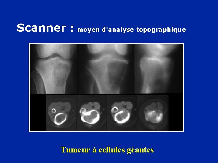 Scanner : moyen d'analyse topographique Tumeur à cellules géantes 