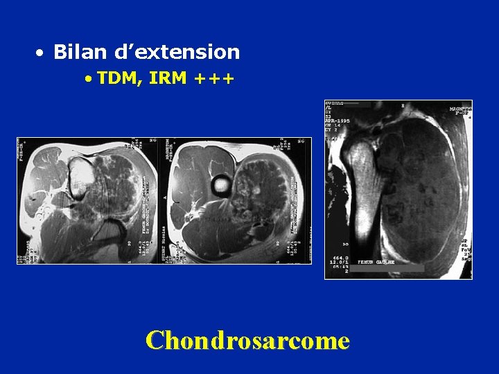  • Bilan d’extension • TDM, IRM +++ Chondrosarcome 